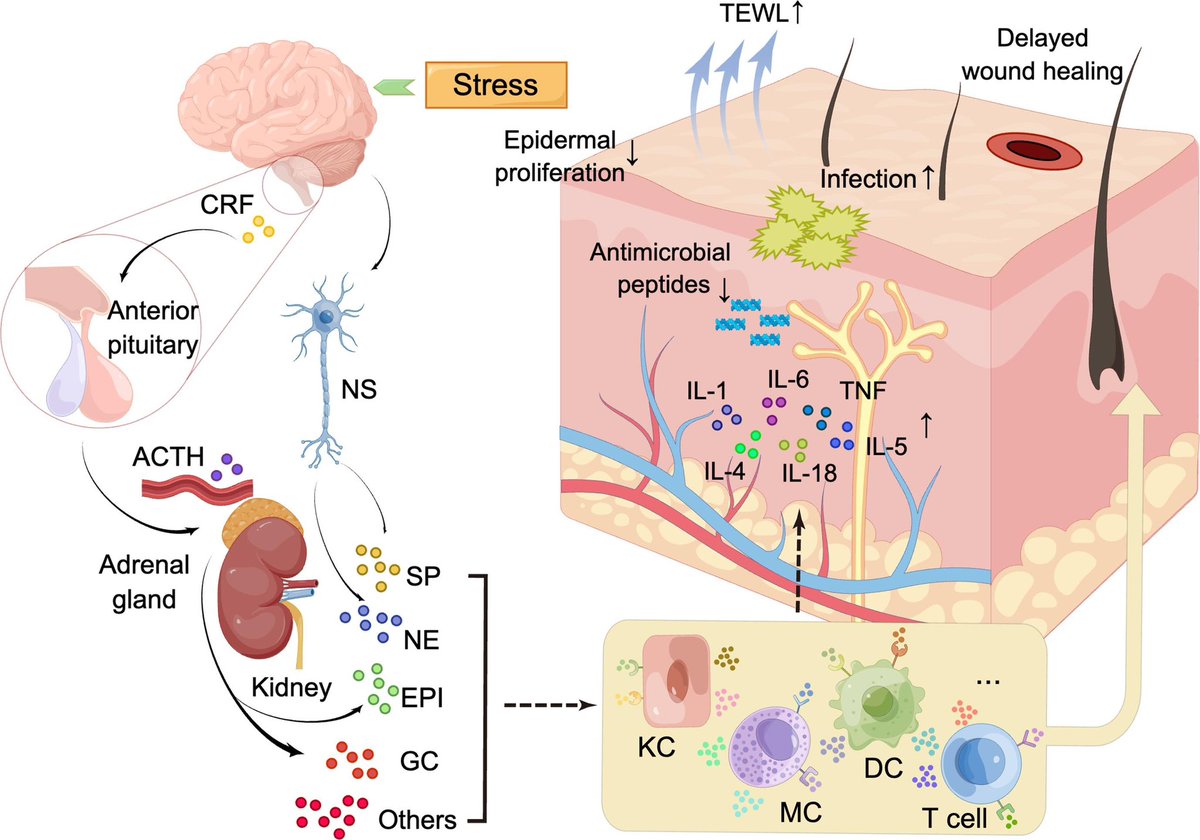 Role of stress in skin diseases: A neuroendocrine-immune interaction view… sciencedirect.com/science/articl…