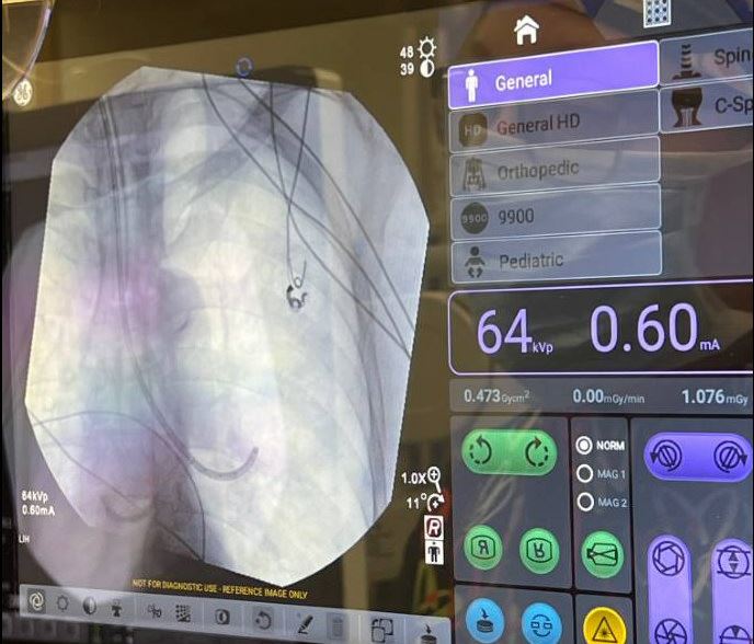 UTSW_RadOnc's tweet photo. Yesterday, our team, led by Drs. Aurelie Garant, @BadiyanMD, and Brian Hrycushko, alongside Dr. @kimstyrvoky, Director of Interventional Pulmonology, completed the first robotically-assisted endobronchial brachytherapy procedure here at UT Southwestern! https://t.co/QTB5zGZsCu