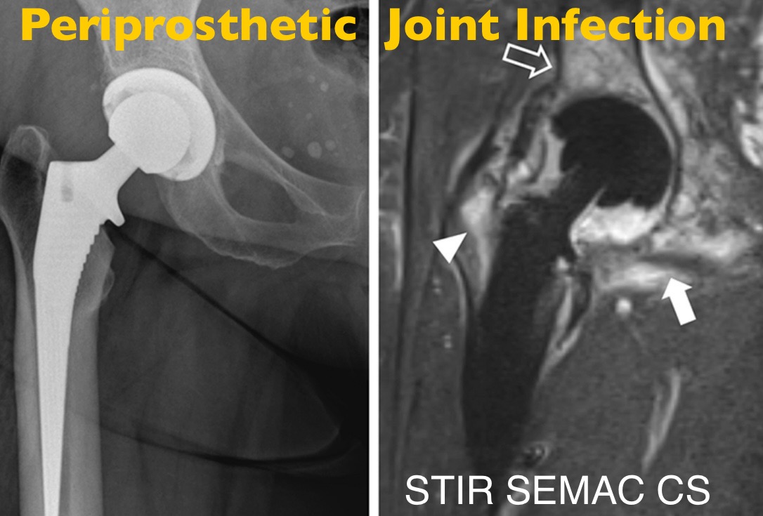 Do you know how to get rid of #MetalArtifacts in #MRI? 👉In this new #OpenAccess review article we describe the current and evolving techniques 👉 Download it here for free: link.springer.com/article/10.100… @derbalgrist | @UZH_en | @SkeletalRadiol | @intskeletal | #MSKrad