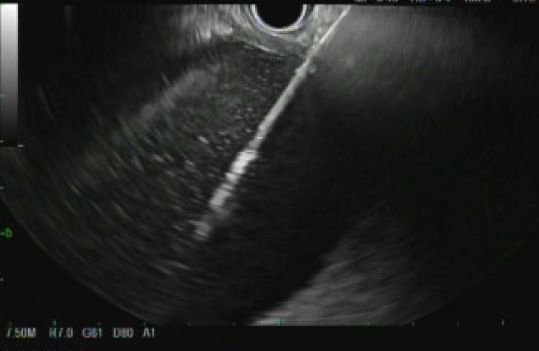 HilarHolzy's tweet photo. 4⃣ STEPS AXIOS Deployment (numbers outlined on AXIOS)

1. Stabilize AXIOS on EUS ▶️connect 🔥🔌▶️unlock catheter lock ▶️ advance catheter control hub (CCH) smoothly (🦶 on 🟨) until catheter is in collection then advance CCH further in (no 🔥)▶️lock

#GITwitter #MedEd @bostonsci https://t.co/QXFfARNBzM