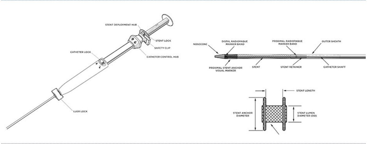HilarHolzy's tweet photo. 4⃣ STEPS AXIOS Deployment (numbers outlined on AXIOS)

1. Stabilize AXIOS on EUS ▶️connect 🔥🔌▶️unlock catheter lock ▶️ advance catheter control hub (CCH) smoothly (🦶 on 🟨) until catheter is in collection then advance CCH further in (no 🔥)▶️lock

#GITwitter #MedEd @bostonsci https://t.co/QXFfARNBzM