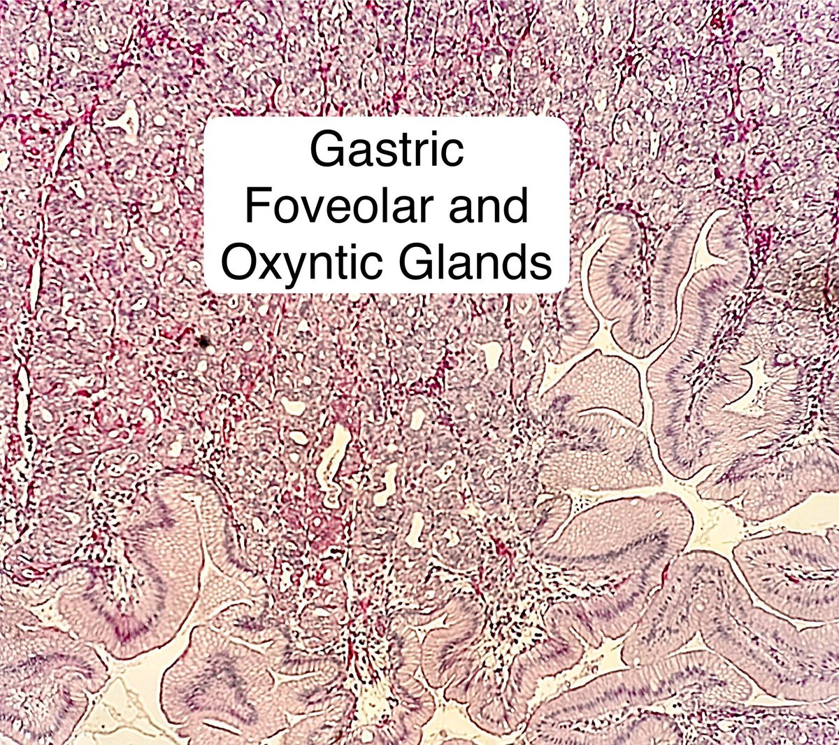 Path4People's tweet image. Meckel’s Diverticulum 

Embryology: Arises from Incomplete Closure of Omphalomesenteric Duct. 

Clinically: Frequent cause of GI bleeding in children &amp;lt; 2 years

Pathology: Can have ectopic tissue like stomach and pancreas 

#pathagonia #pedspath #medpath #medicalstudent #gi #surg