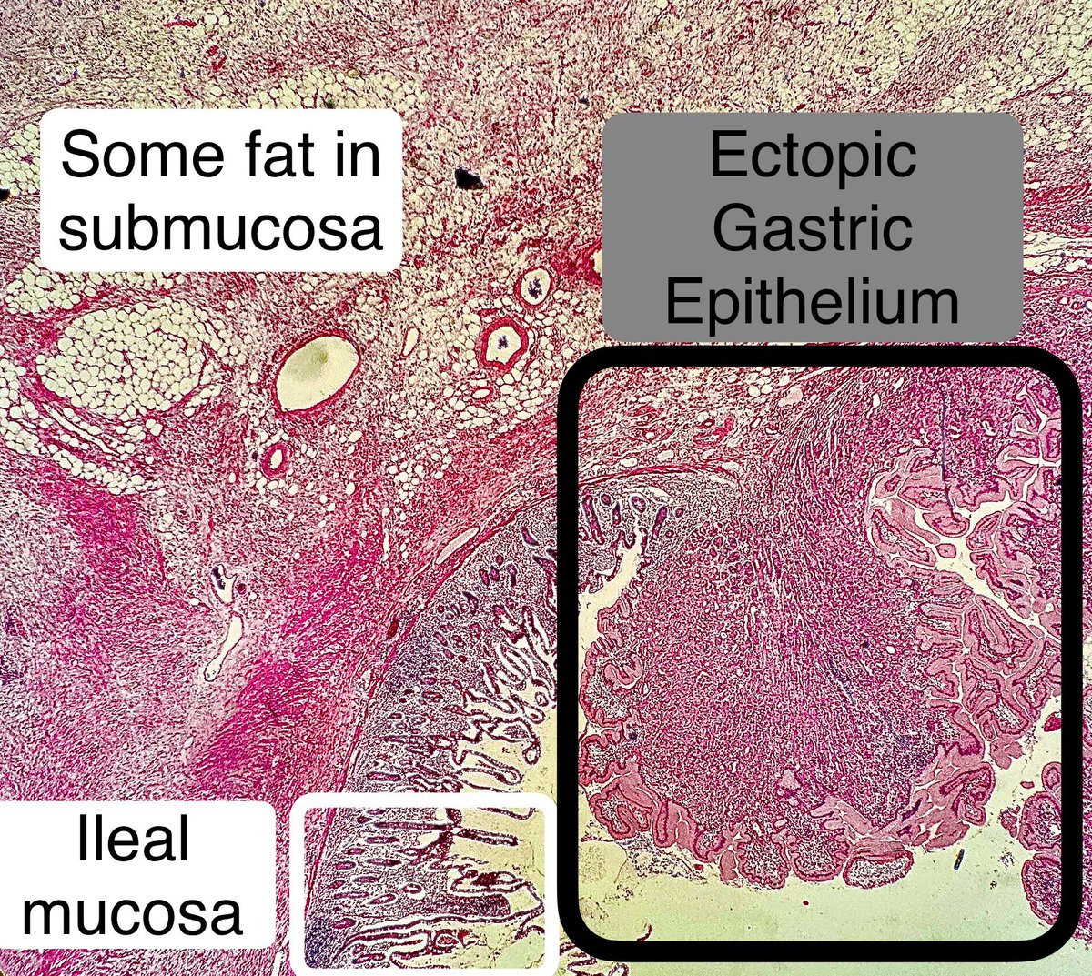 Path4People's tweet image. Meckel’s Diverticulum 

Embryology: Arises from Incomplete Closure of Omphalomesenteric Duct. 

Clinically: Frequent cause of GI bleeding in children &amp;lt; 2 years

Pathology: Can have ectopic tissue like stomach and pancreas 

#pathagonia #pedspath #medpath #medicalstudent #gi #surg