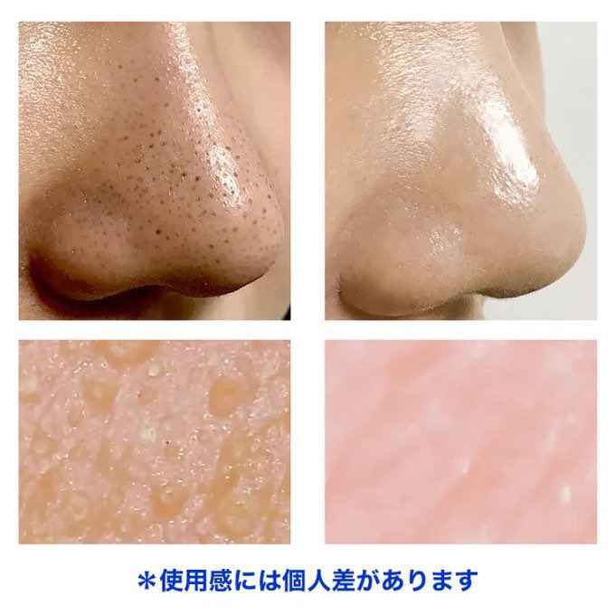himemi__ya_'s tweet photo. 超有名なノーズピーリング使ってみたけど “鼻の黒ずみ綺麗にならなかった“と言う声が多すぎて本当にもったいない。私も使い方通りに試したけど黒ずみはホントの事を言うと消えなくて、ゴミ箱に捨てかけた。ある方法を試すだけで一撃で黒ずみがあっという間に目立たなくなったの。その方法は… https://t.co/Ozs5M49gzp