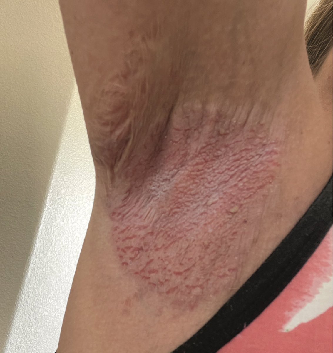 In this article, we present a patient with a history of recalcitrant HHD who had clearance of her current disease flare with the topical JAK inhibitor #ruxolitinib.

Read The Case Report: okt.to/BCY6E3

#HaileyHailey #Derm #Dermatology #Dermatologist #DermInsights