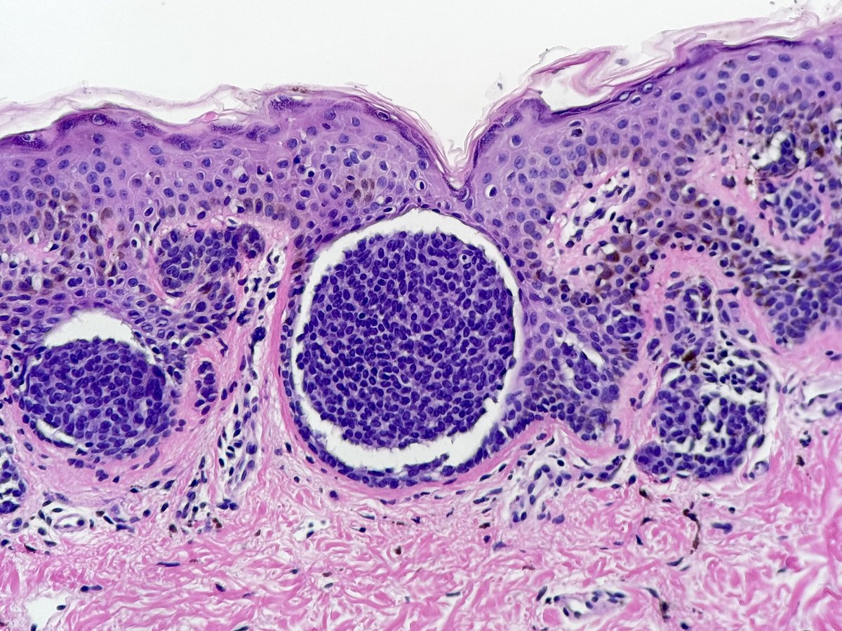 A “floating nest” Ring-like cleft around a nevus nest. In nevi, they are mostly -but not exclusively- seen in Spitz tribe. Also, clefts have been proposed as a adjuvant clue for a dx of melanoma (Bernie’s Clue 34). #dermpath #pathtwitter #tooprettynottoshare