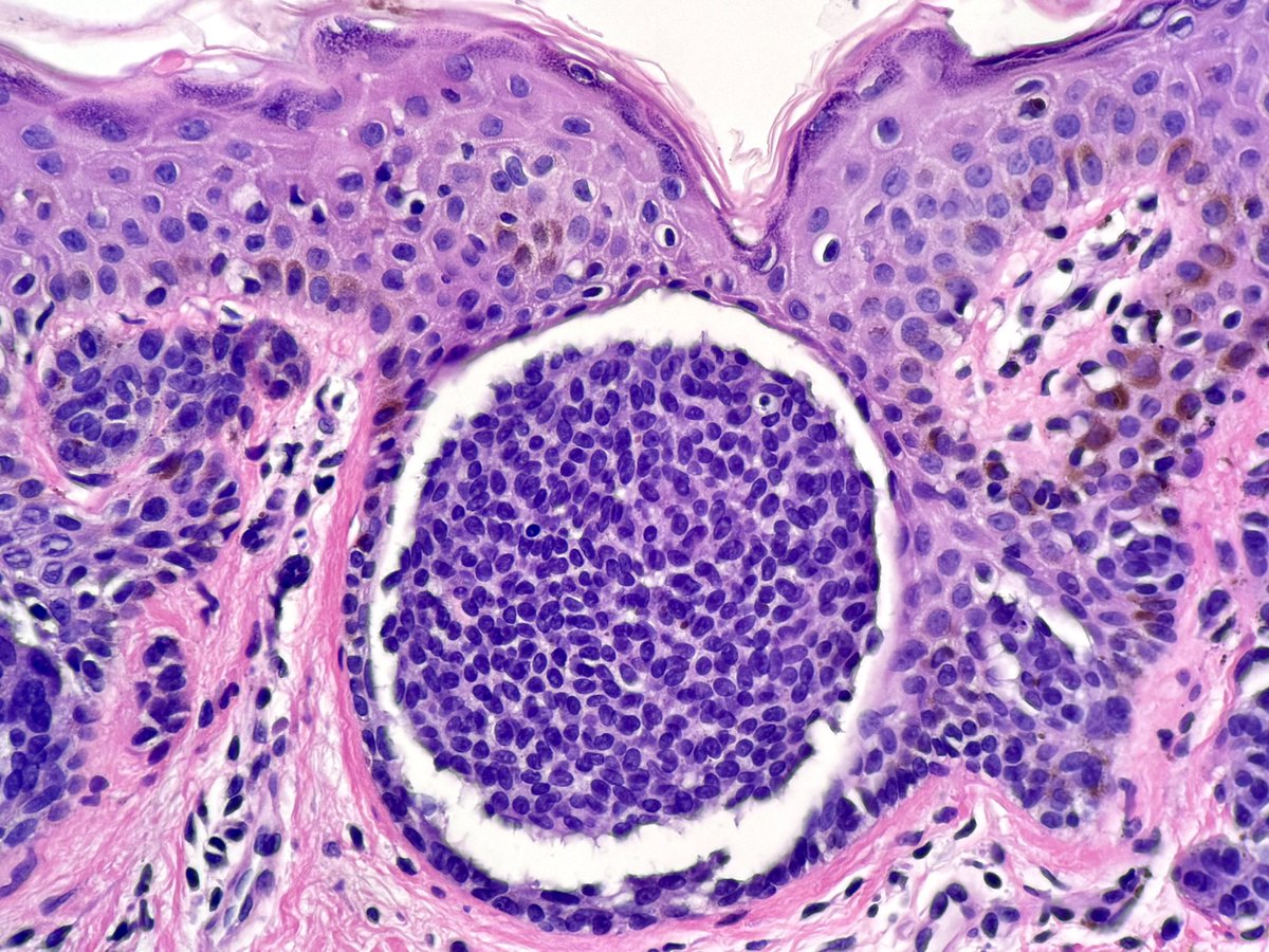 DiegoMoralesN's tweet photo. A “floating nest”
Ring-like cleft around a nevus nest. In nevi, they are mostly -but not exclusively- seen in Spitz tribe. Also, clefts have been proposed as a adjuvant clue for a dx of melanoma (Bernie’s Clue 34). #dermpath #pathtwitter #tooprettynottoshare https://t.co/QtF5nFPxEG