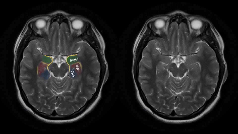 Do not be the neurologist who calls the Amygdala a Hippocampus!

Lateral ventricle is an inverted 'L'
In front of the short arm &gt; amygdala
behind &gt; hippocampus head shouldering the lateral ventricle.
The parahippocampal gyrus photobombs this beauty!

#SaturdayNight_Neuroimaging