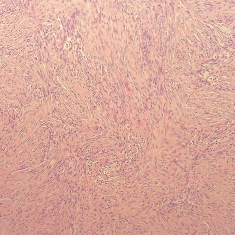 Does a particular buzzword come to mind to describe this lesion, #pathresidents? Let's say this is a forearm mass in a 30-something man. #BSTPath #PathTwitter #PathX