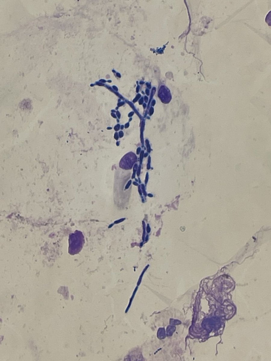 When the tech marked 'yeast' on the path review form for this BAL, I thought I might barely see subtle little maybe-yeasts. But look at this!

#Microbiology #PathTwitter #PathX #Cytopathology