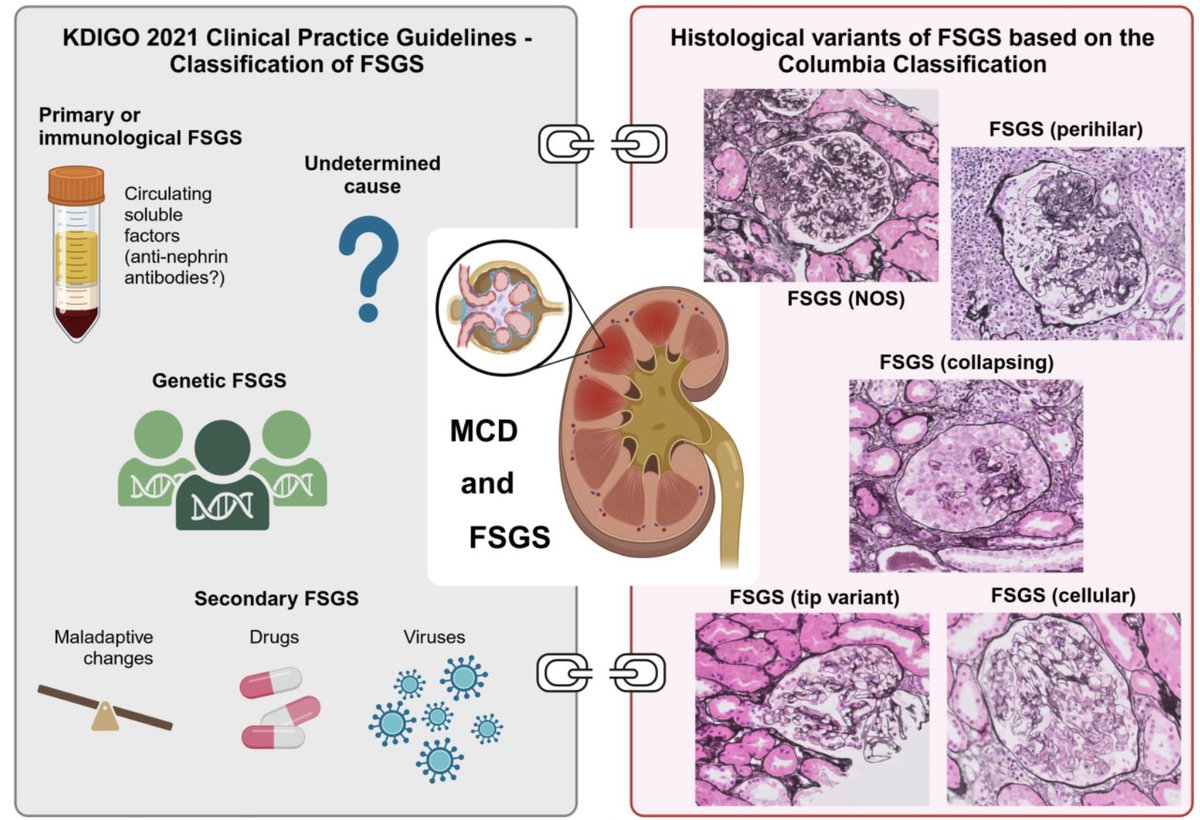 Andreas Kronbichler (@akronbichler) on Twitter photo 🚨 The <a href="/ERAkidney/">ERA - European Renal Association</a> Immunonephrology Working Group is proud to share our latest publication, focusing on the management of adult patients with podocytopathies (MCD and FSGS). We propose that rituximab should be upgraded in the next KDIGO update ...
academic.oup.com/ndt/advance-ar… 🚨 The <a href="/ERAkidney/">ERA - European Renal Association</a> Immunonephrology Working Group is proud to share our latest publication, focusing on the management of adult patients with podocytopathies (MCD and FSGS). We propose that rituximab should be upgraded in the next KDIGO update ...
academic.oup.com/ndt/advance-ar…