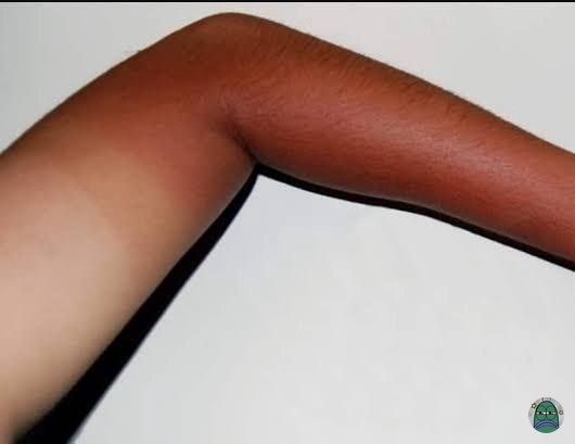 💚 guys spill produk yang cepet ngaratain kulit belang honest review ya tapi