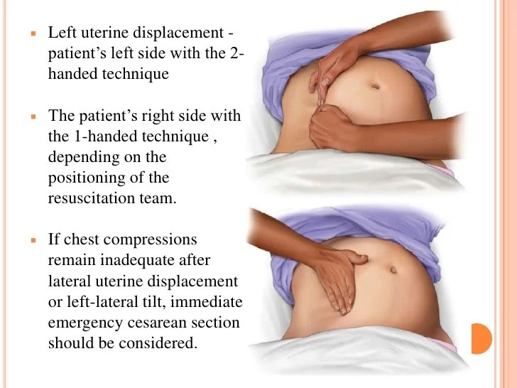 Our #AHAWIC @GoRedForWomen is sharing facts re:🫀disease in #women #CardioEd #cardioobstetrics Cardiac Arrest in 🤰🏻 🫀Resuscitation of 🤰🏻in 27°–30° left-lateral tilt position results in lower quality chest compressions. (19% ⬇️ in compression depth rates than resuscitations