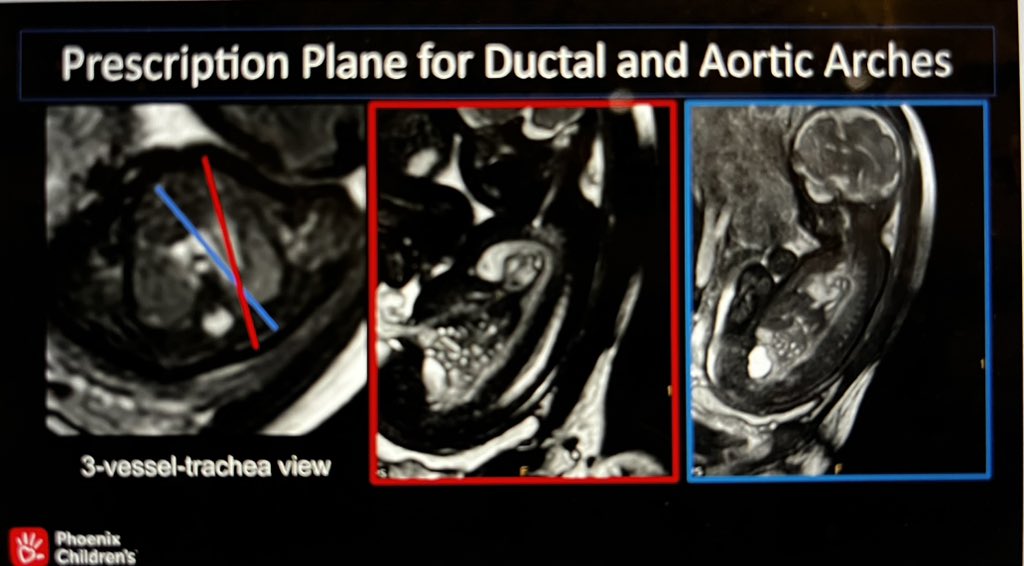 #SMFM24 advance fetal imaging