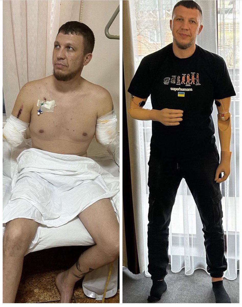 In June 11, family Petchenko’s lives were forever changed. Sergiy lost both arms and part of his right foot. Months of recovery, rehabilitation, along with fitting and working with prosthetics, Sergiy learns to adapt to artificial hands and dreams of regaining his independence