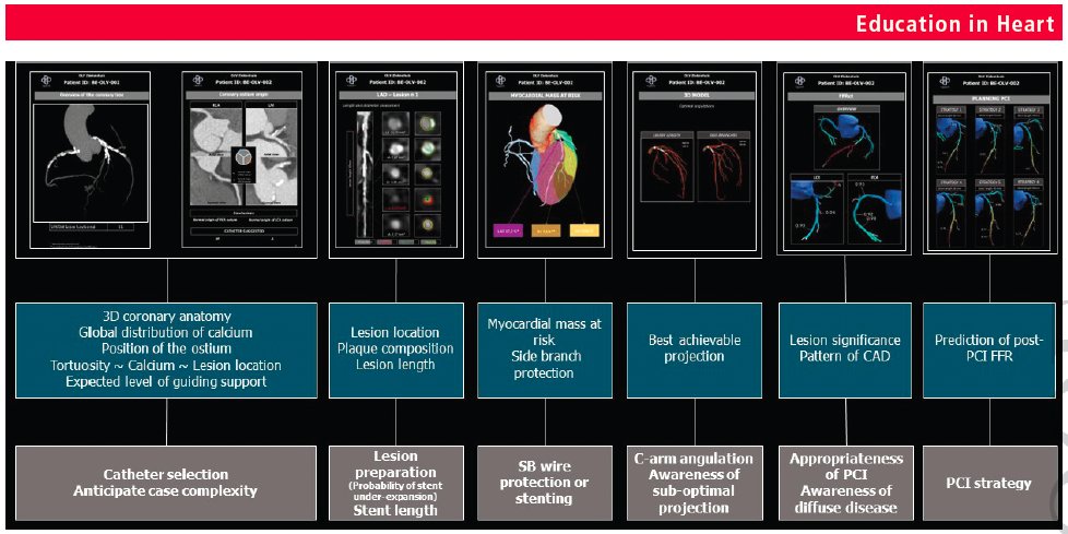 Very insightful review on #CTguidedPCI by @bouissetfred in @Heart_BMJ 'In summary, PCI planning reduces uncertainty, enhances decision-making, improves procedural efficiency, promotes collaboration and facilitates effective communication with patients' heart.bmj.com/panels_ajax_ta…