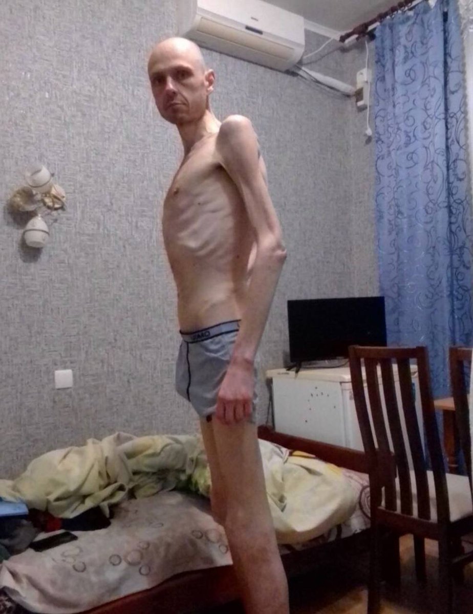 igorsushko's tweet image. Russian fascists did this. This man survived until he was exchanged after 20 months in concentration camps. How many Ukrainians didn't?