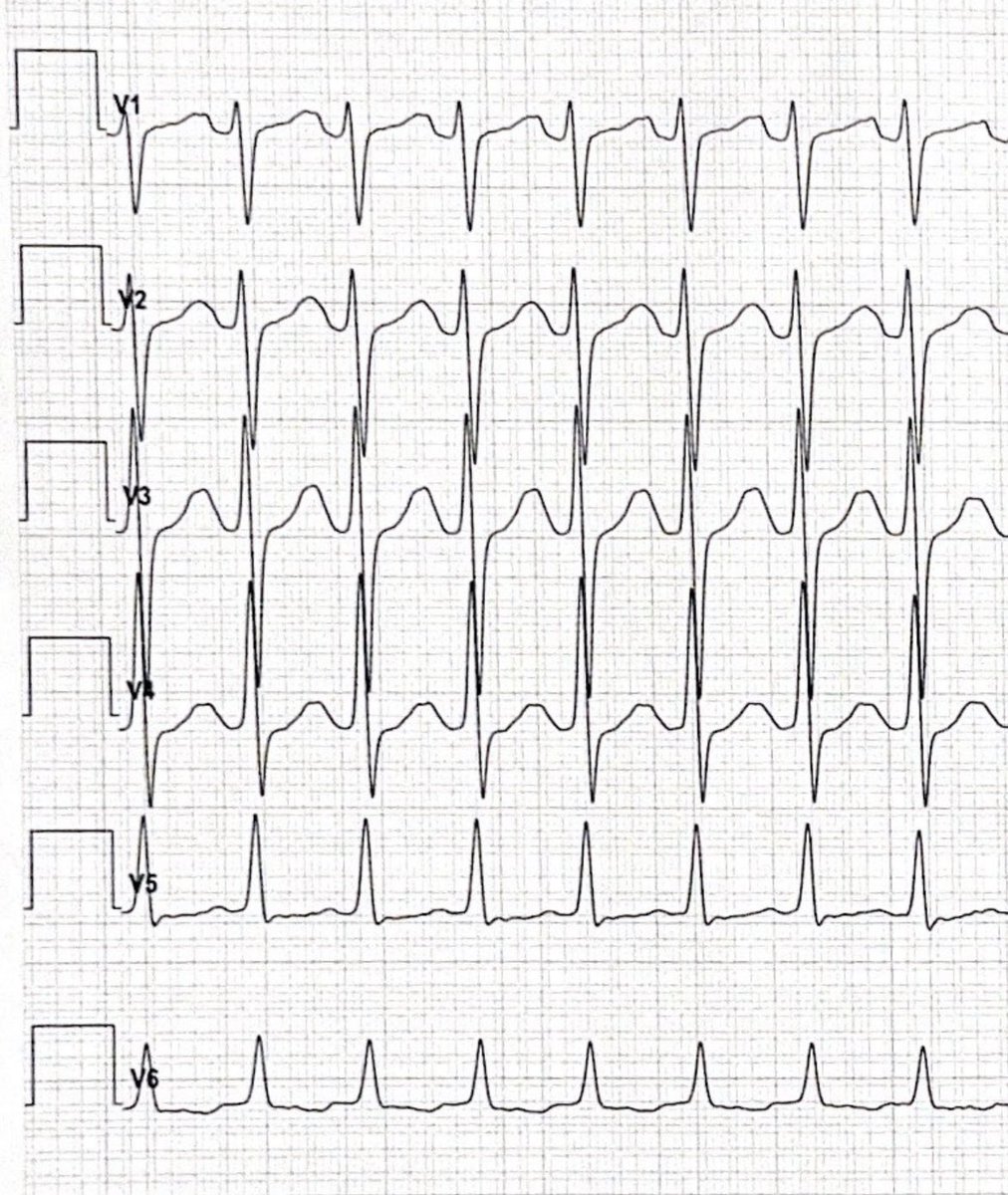 ChristianHeeger's tweet photo. You miss #EP on the weekend?
Be part of the #RhythmoRiddle🫀⚡️🩺
👉What’s the most likely location of the concealed pathway in this 5 year old kid?
🤔❓
Pol below: 👇❗️
@agep @RolandTilz @evgeny_lyan @bordistef @Phiso_de @DrV_Mann @DavidDuncker @sebFeickert @laura_rottner https://t.co/hNGwOfSKtA