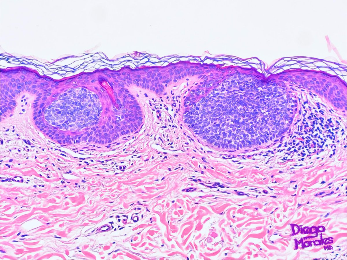DiegoMoralesN's tweet photo. A sort of pseudo-#EyelinerSign, focal finding in a superficial basal cell carcinoma showing some intraepidermally located nests above the dermoepidermal junction. The IHC is BerEp4. #dermpath #pathtwitter #tooprettynottoshare #pathfulness #freudeandermorphologie https://t.co/RQDlapo5Cb