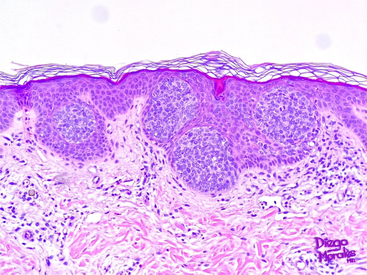 DiegoMoralesN's tweet photo. A sort of pseudo-#EyelinerSign, focal finding in a superficial basal cell carcinoma showing some intraepidermally located nests above the dermoepidermal junction. The IHC is BerEp4. #dermpath #pathtwitter #tooprettynottoshare #pathfulness #freudeandermorphologie https://t.co/RQDlapo5Cb
