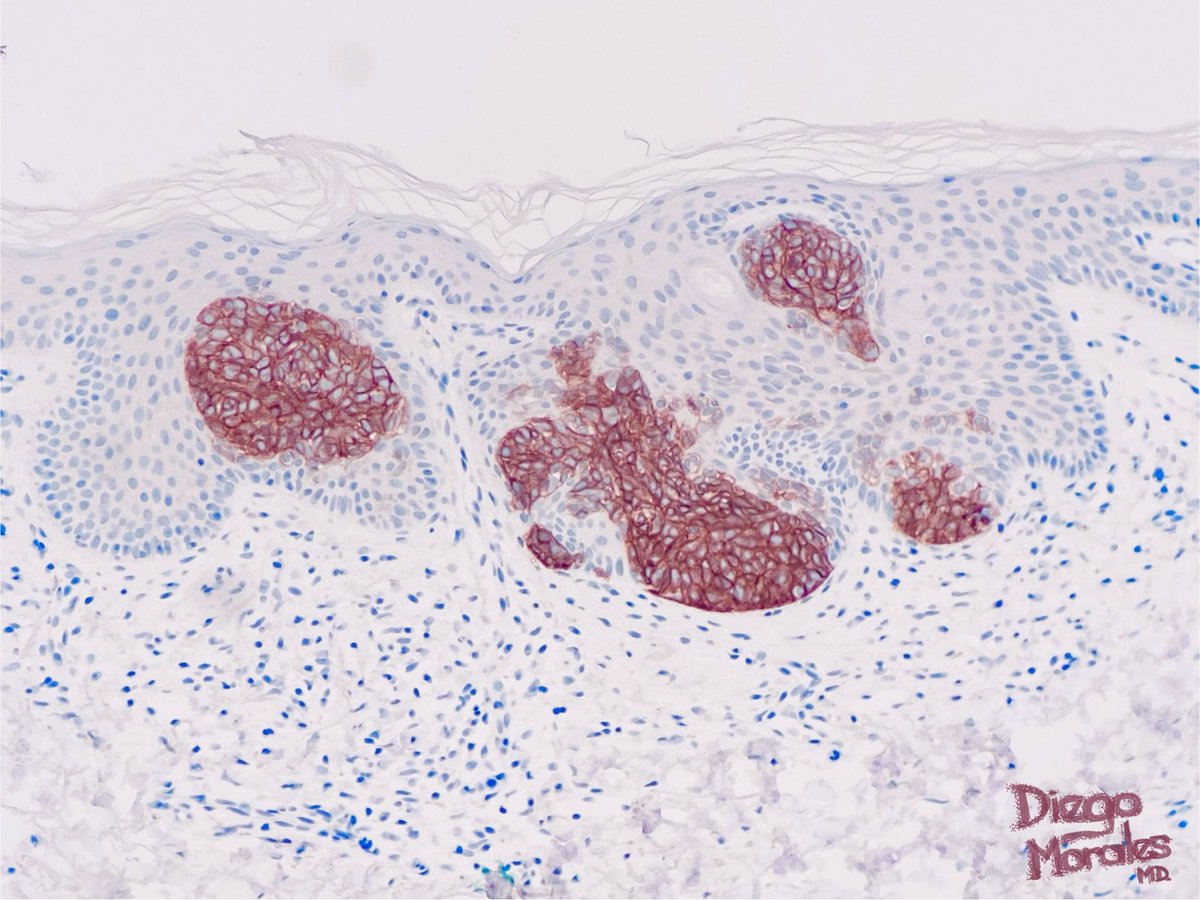 DiegoMoralesN's tweet photo. A sort of pseudo-#EyelinerSign, focal finding in a superficial basal cell carcinoma showing some intraepidermally located nests above the dermoepidermal junction. The IHC is BerEp4. #dermpath #pathtwitter #tooprettynottoshare #pathfulness #freudeandermorphologie https://t.co/RQDlapo5Cb