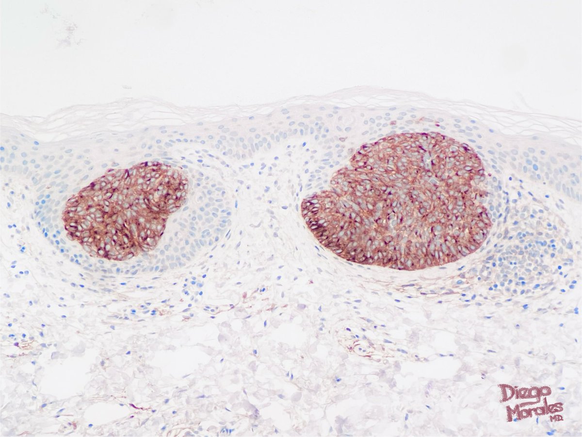A sort of pseudo-#EyelinerSign, focal finding in a superficial basal cell carcinoma showing some intraepidermally located nests above the dermoepidermal junction. The IHC is BerEp4. #dermpath #pathtwitter #tooprettynottoshare #pathfulness #freudeandermorphologie
