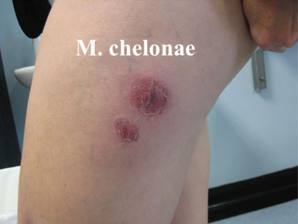 Path4People's tweet photo. Microbiology:
Mycobacteria are slow growing; even RAPID growing is defined by growth typically < 7 days
Rapid Growing Species include:
M. abscessus
M. chelonae
M. fortuitum
#pathagonia #microx #microbiology #pathcritter #mycobacteria #medstudentx #infectiousdisease #medx https://t.co/5Kmi1aDWJ7