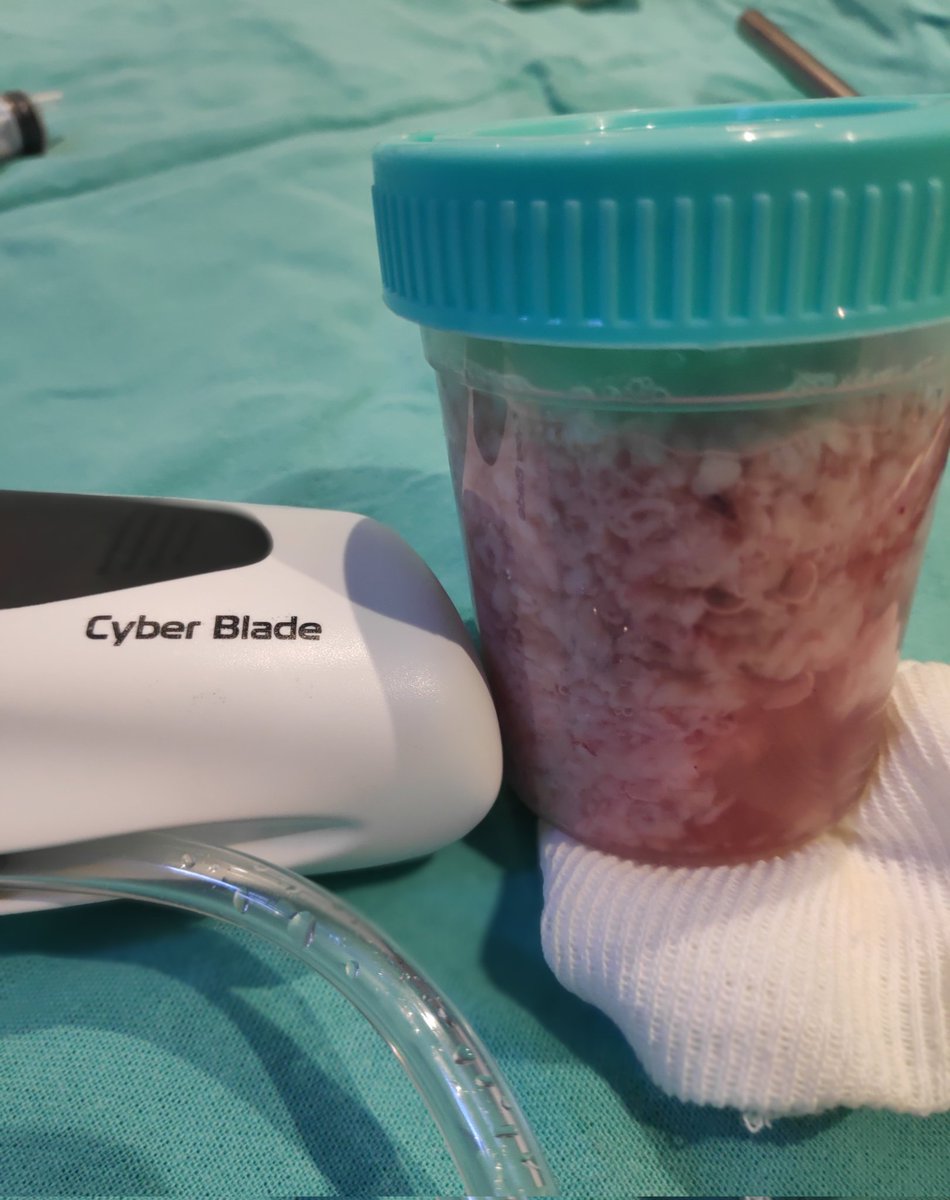 DrValladaresP's tweet photo. Elegir un buen morcelador es tan o más importante que un láser de alta potencia. 116 gr 11 min. #HOLEP #aeep #MiLEP #cyberblade #quanta_surgery @LucaMartinel https://t.co/GYQnA4kn32