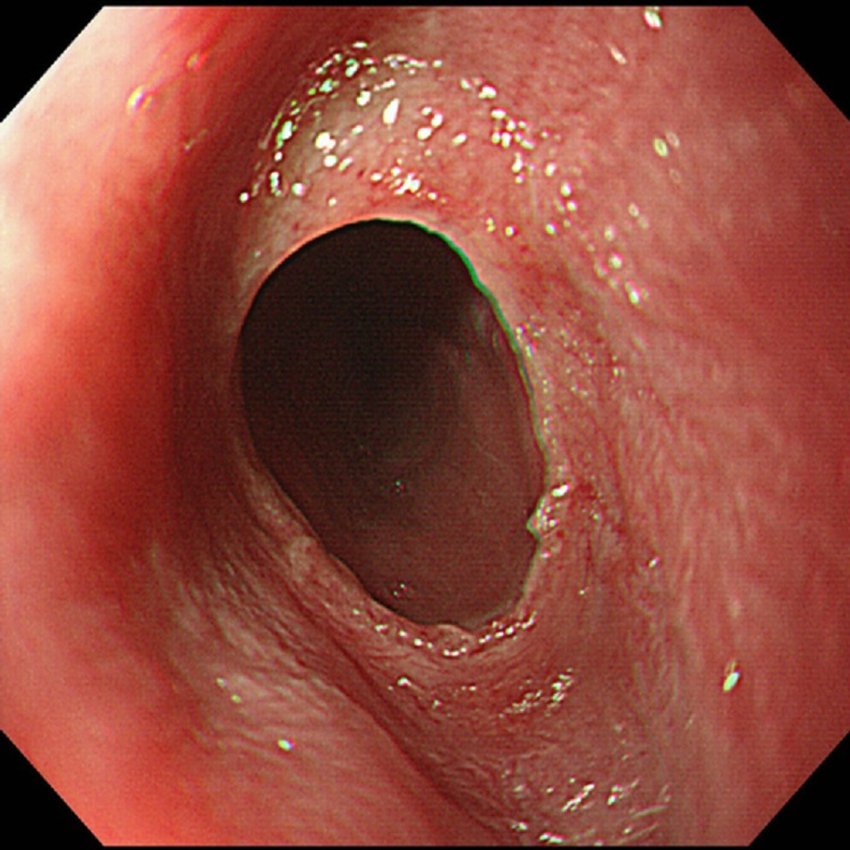 IhabFathiSulima's tweet photo. Dysphagia and Fatigue.
What is the Syndrome? Two names.
What is the importance?
Epidemiology? https://t.co/CX3aWEad24