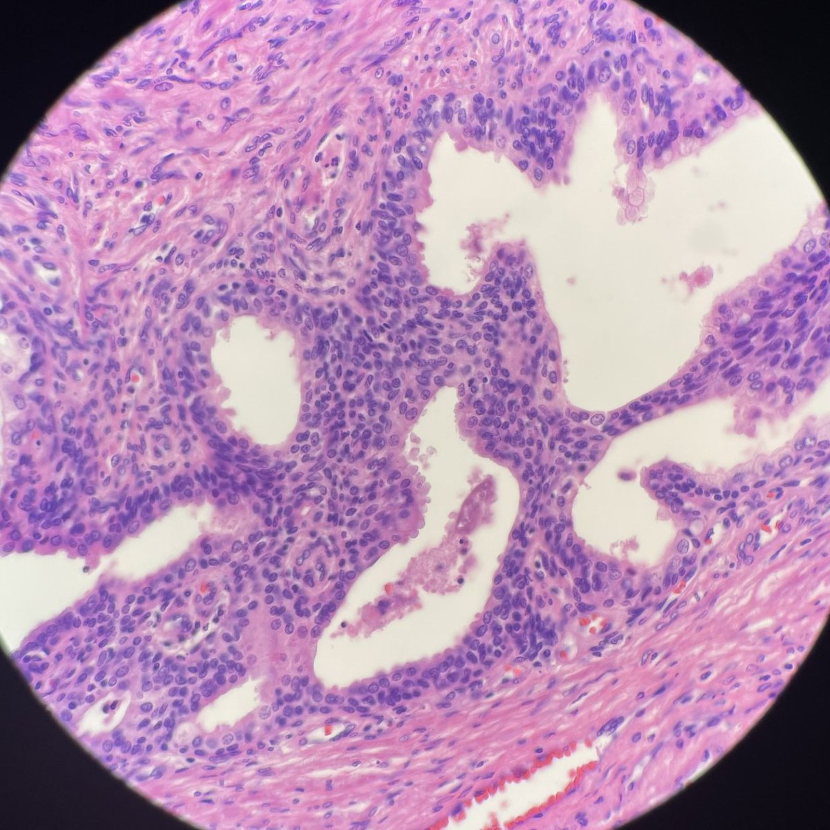 One of the most important things about prostate pathology is recognizing benign mimics of adenocarcinoma. This is just basal layer hyperplasia with a pseudocribriform pattern. #PathTwitter #GUPath