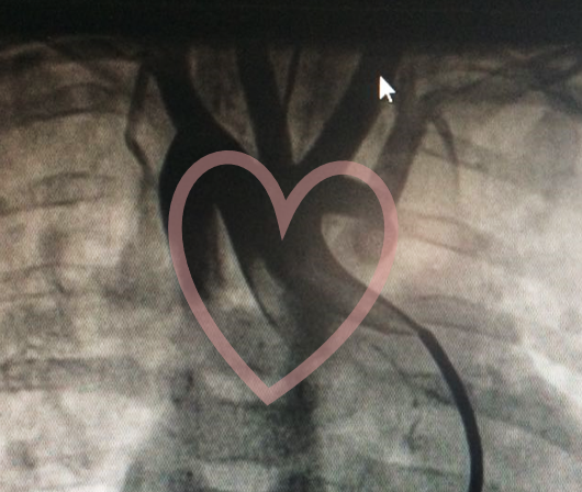 CardioCaribeMx's tweet photo. FELIZ DÍA DE LAS CARDIOPATÍAS CONGÉNITAS !!!

Dicen que esto: 🫀 no se parece a esto: ♥️
Las CC nos demuestran que sí

#Corazonesrotos #14feb #CHD #restrictiva #doblearco https://t.co/dPgLeB75bk