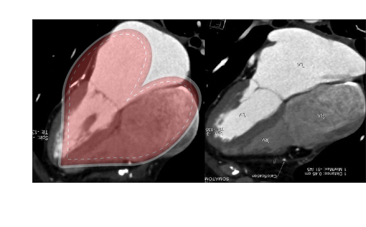 CardioCaribeMx's tweet photo. FELIZ DÍA DE LAS CARDIOPATÍAS CONGÉNITAS !!!

Dicen que esto: 🫀 no se parece a esto: ♥️
Las CC nos demuestran que sí

#Corazonesrotos #14feb #CHD #restrictiva #doblearco https://t.co/dPgLeB75bk