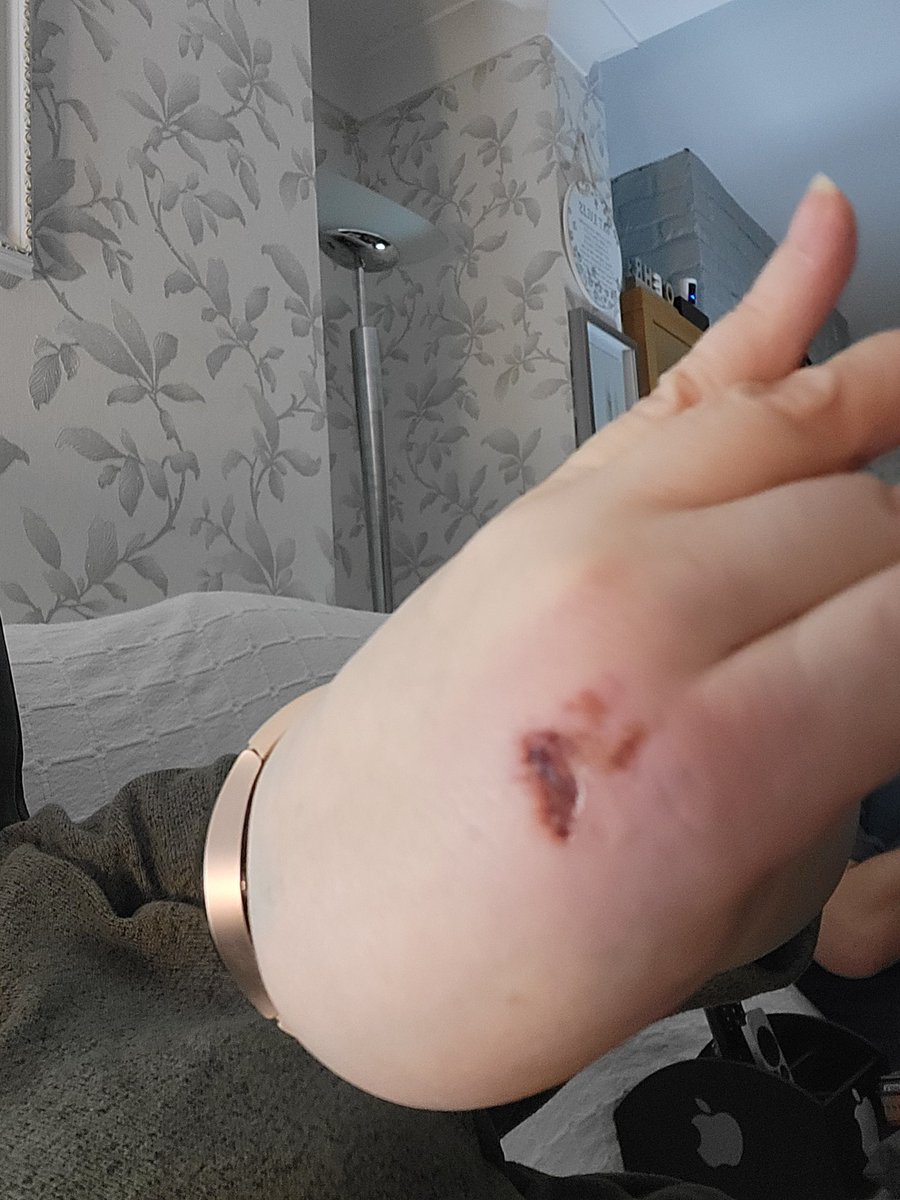 Katelouise23981's tweet photo. Aftermath #warwound #fallover https://t.co/7OxmWxnAID
