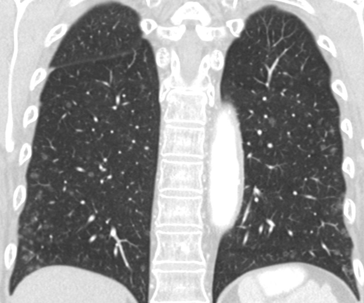 The image can speak for itself! 1️⃣What is the sign called? 2️⃣What are the differentials and what is the probable diagnosis? @futureradres @RadDiscord @RadiologyCTI #MedEd #RadEd #chestrad #Cardiothoracicimaging