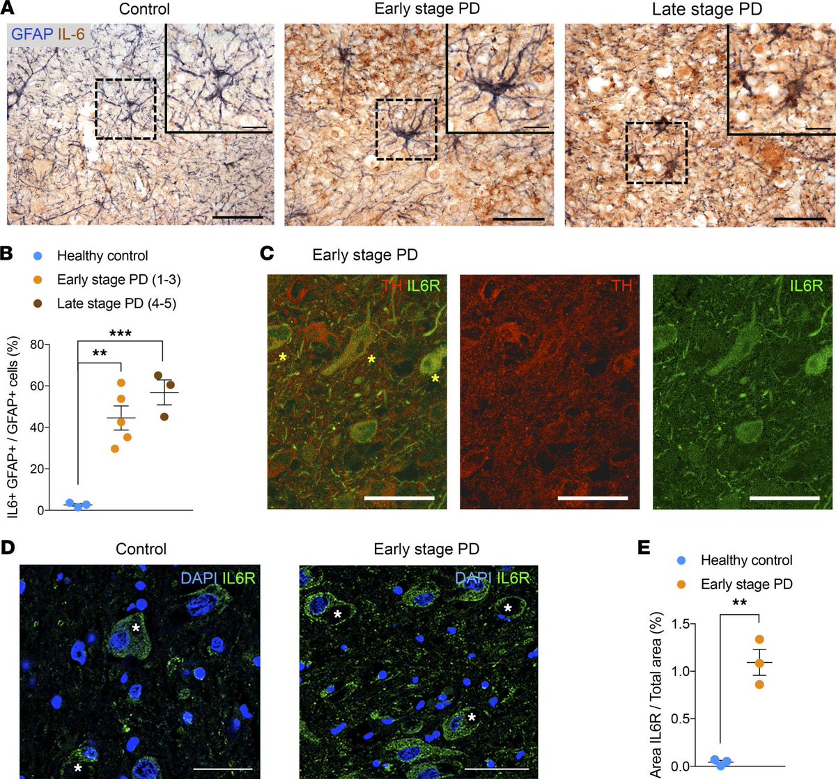 ScienceofPD's tweet photo. New research reports that blocking IL-6 signaling (with Tocilizumab) prevents astrocyte-induced neurodegeneration in an iPSC-based model of #Parkinsons; IL-6/IL-6R signaling is increased in the SNc in postmortem brains at early stages of PD
https://t.co/MecaQpuZMW https://t.co/vtZODENse1