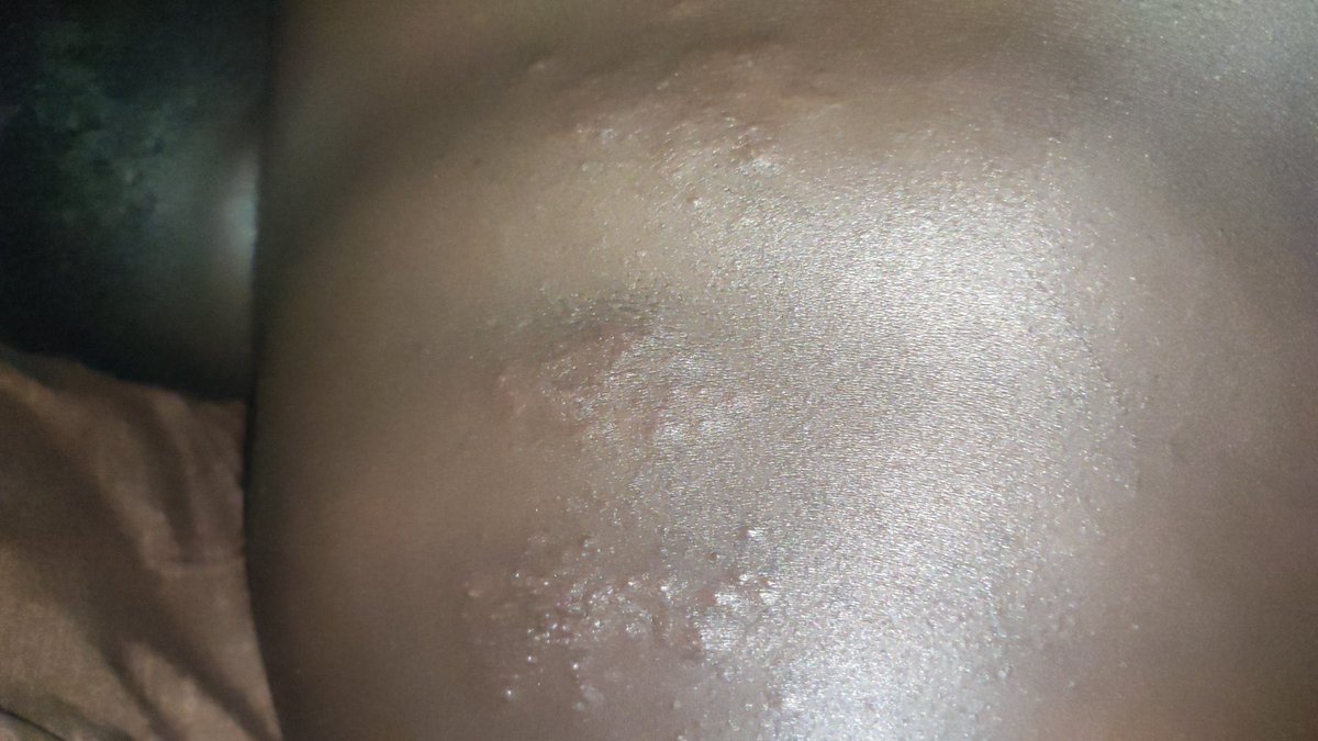 drkeithsiau's tweet photo. This is a #TwitterConsult from Uganda - patient reports left arm pain from armpit to biceps and notices this rash on their upper back. What’s the diagnosis? #WithConsent https://t.co/Y1Rcgpvg0S