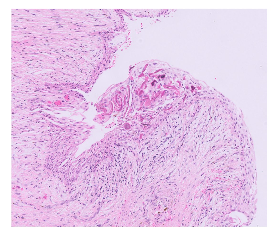 Mandible cyst .. question for raidents what do you call this ! ?

#pathtwitter #surgpath #pathology #pathologyfamily