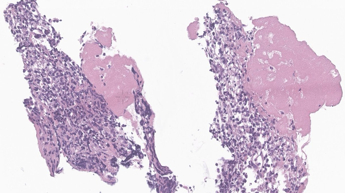 EricMadPatho's tweet photo. 54/M with Epstein anomaly and severe TR found a 6cm mass in RV by follow-up MRI. Endomyocardial biopsy revealed a cardiac DLBCL, EBV-negative, C-Myc FISH negative. More common in the right atrium.  #CVpath #cardiacpath #hemepath #pathtwitter #pathresident https://t.co/VKgCfHnpnw