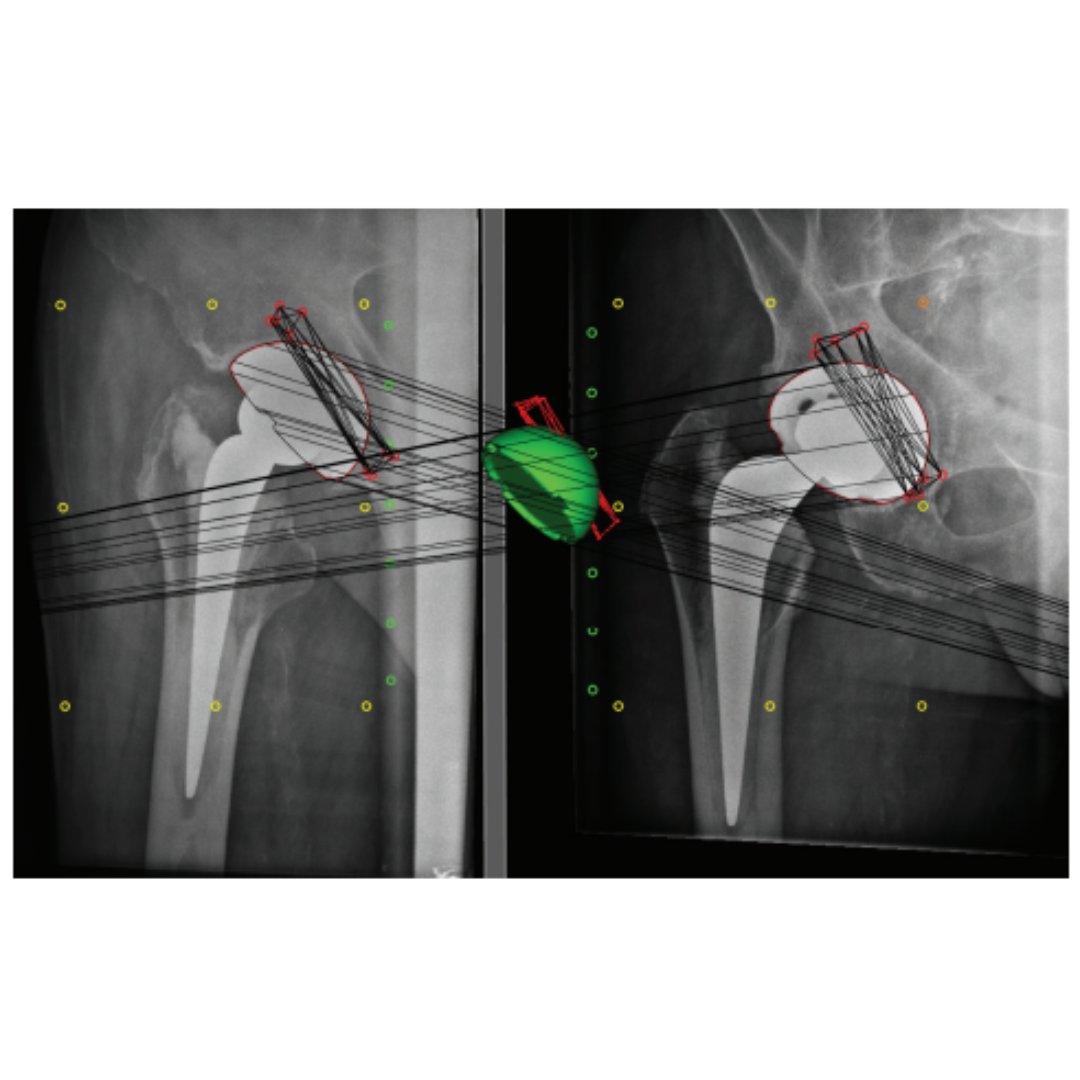 BoneJointJ's tweet image. The Trident II clusterhole hydroxyapatite (HA) shell has comparable migration with its predecessor, the Trident hemispherical HA cluster shell, suggesting a similar risk of long-term aseptic loosening.

#BJJ #Arthroplasty #Radiograph

ow.ly/27Yj50QvRmx