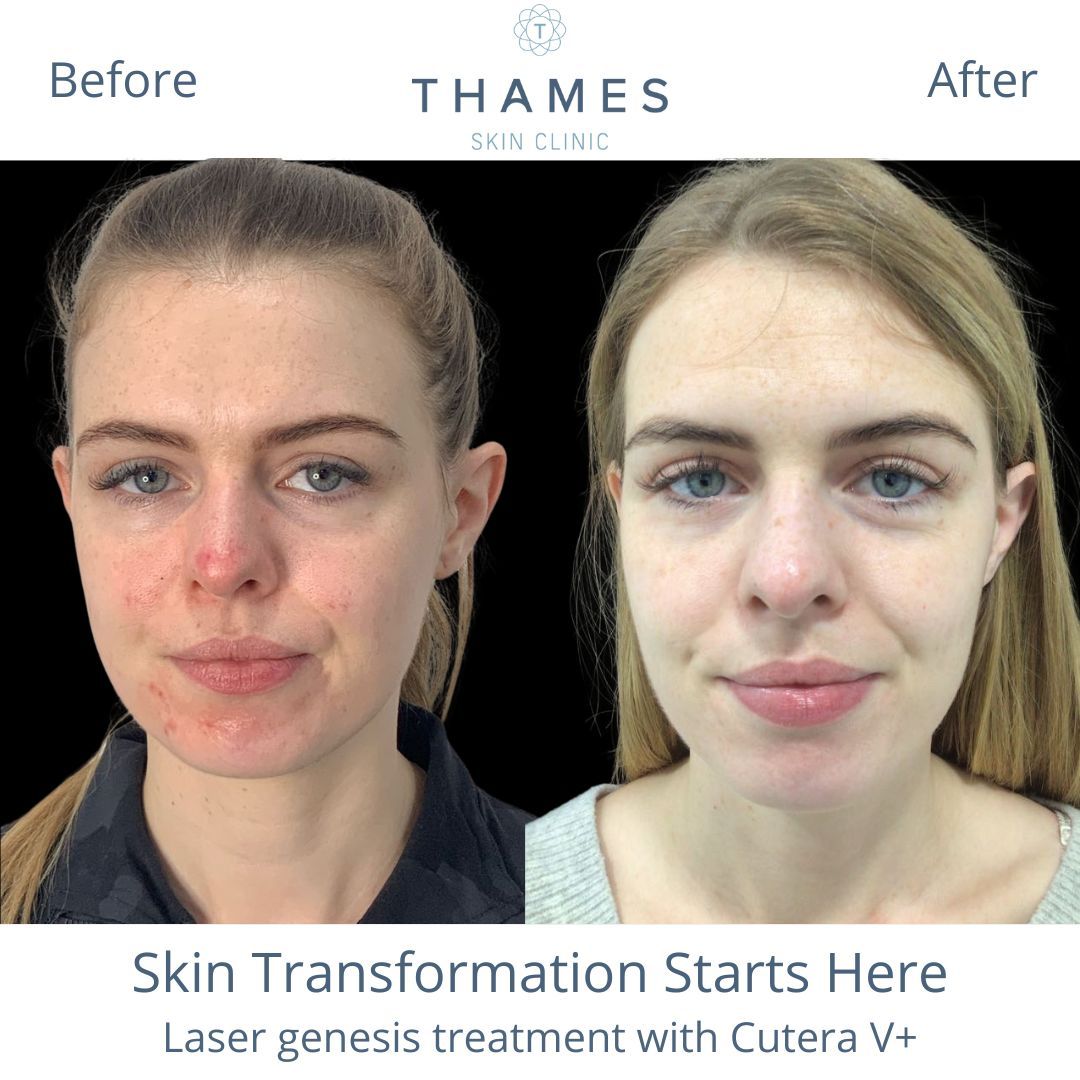 Experience the Power of Laser Genesis by Cutera V+! 💫 

Unlock Your Skin's Potential Today! 🌟 

#LaserGenesis