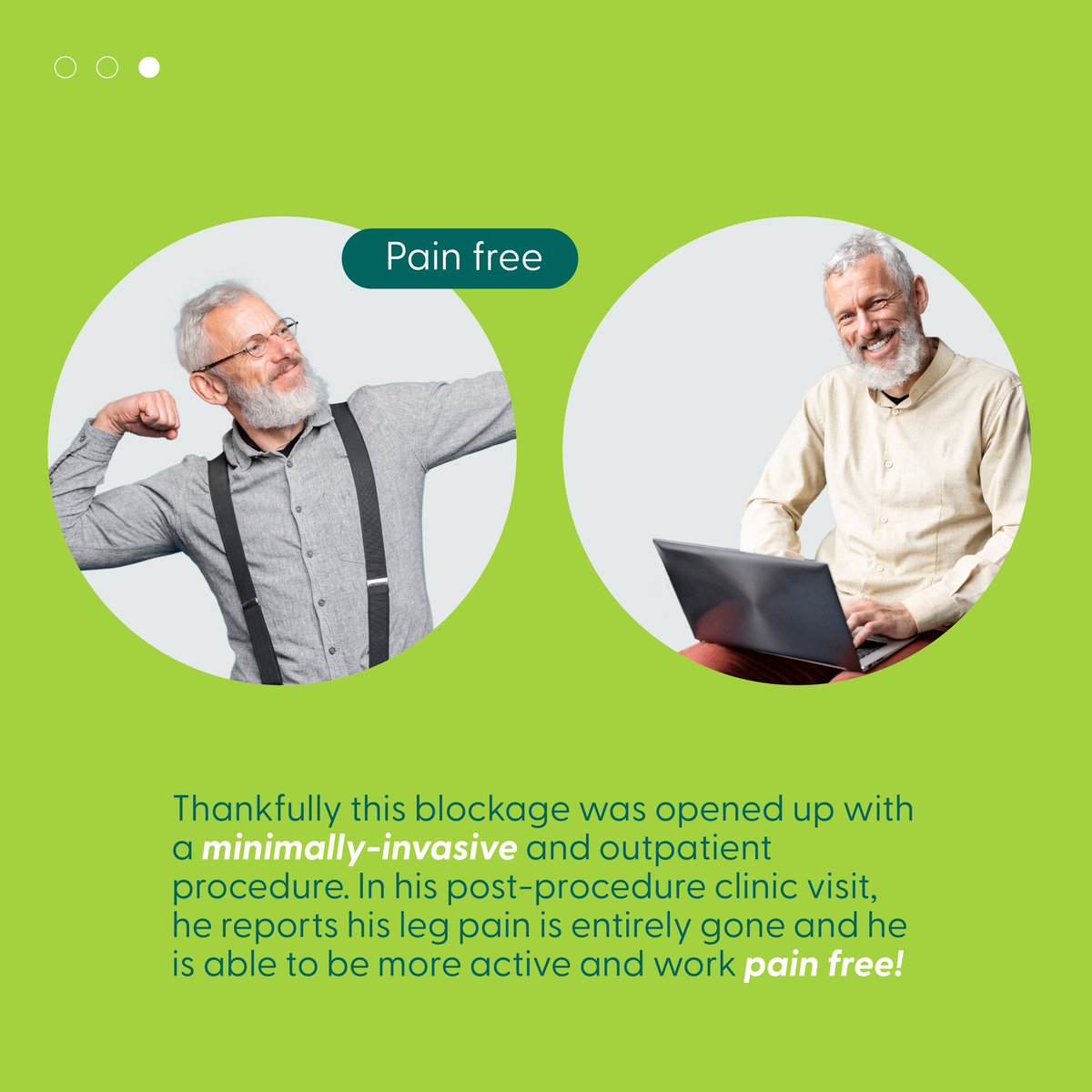 Discover a remarkable transformation: Our 57-year-old patient, a former smoker with diabetes, found relief from persistent calf pain through a minimally-invasive procedure. Now pain-free and active, he's enjoying a new quality of life.