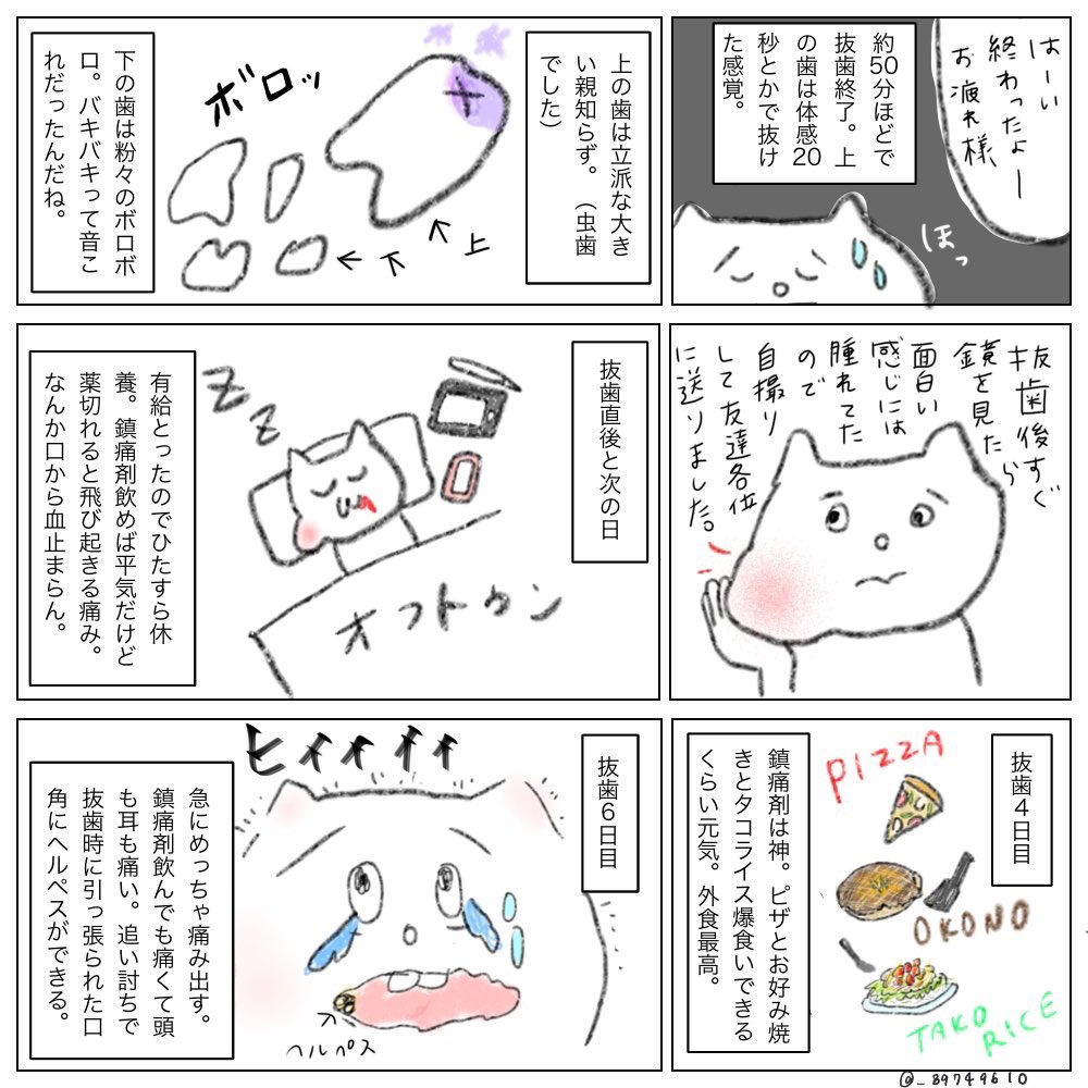 _89749610's tweet photo. 歯列矯正はじめて1年半、1番痛かったことは水平埋伏歯の抜歯時にドライソケットになったこと💀🦷これは当時痛すぎて病みすぎて殴り書きした抜歯レポ💀🦷 https://t.co/6oCQNlUflM