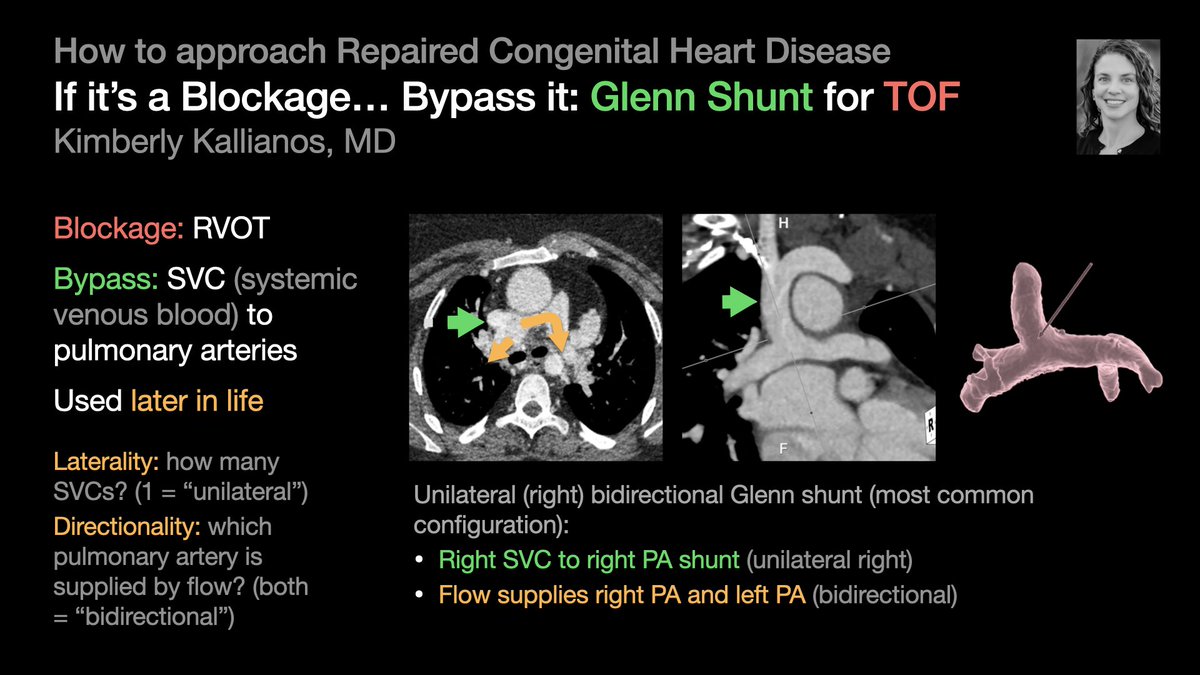 thoracicrad's tweet photo. A Plumber’s Approach to Repaired Congenital Heart Disease:

Blockage → Bypass it [3/5]

…from @KimKallianos’s talk at #STR2022 &amp; condensed by @MikeHarowiczMD.

#radres #Radtwitter #MedTwitter #FOAMrad #FOAMmed https://t.co/N6FPbtM0cr
