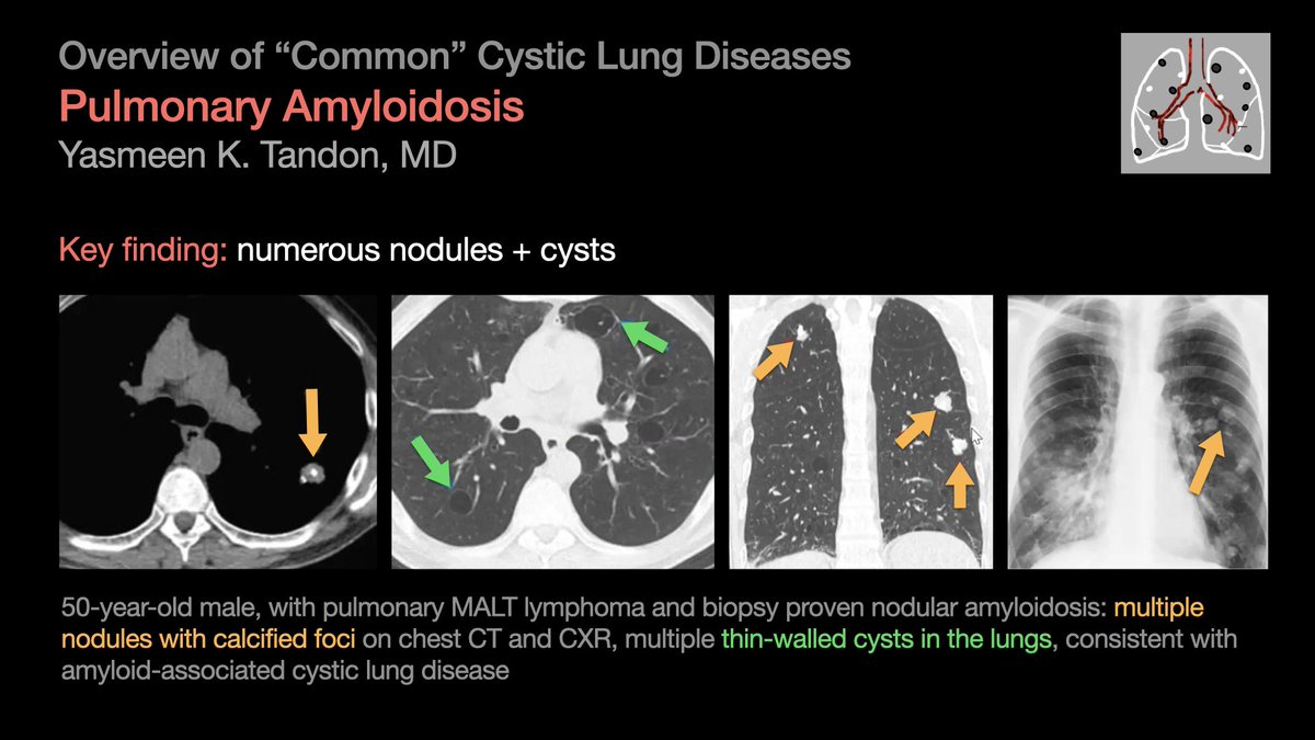 Overview of “Common” Cystic Lung Diseases: Lymphoid Interstitial Pneumonia (LIP) & Pulmonary Amyloidosis [3/5] …from Dr. Yasmeen Tandon’s talk at #STR2021 & condensed by @hannadallapria. #radres #Radtwitter #MedTwitter #FOAMrad #FOAMmed
