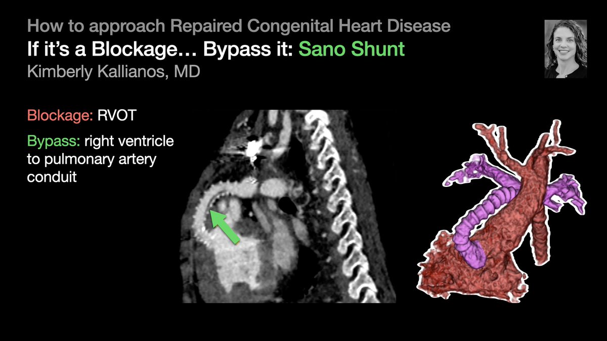 thoracicrad's tweet photo. A Plumber’s Approach to Repaired Congenital Heart Disease:

Blockage → Bypass it or Open it [4/5]

…from @KimKallianos’s talk at #STR2022 &amp; condensed by @MikeHarowiczMD.

#radres #Radtwitter #MedTwitter #FOAMrad #FOAMmed https://t.co/fm47ryUh18