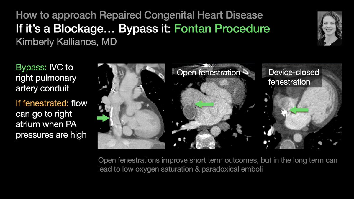 thoracicrad's tweet photo. A Plumber’s Approach to Repaired Congenital Heart Disease:

Blockage → Bypass it or Open it [4/5]

…from @KimKallianos’s talk at #STR2022 &amp; condensed by @MikeHarowiczMD.

#radres #Radtwitter #MedTwitter #FOAMrad #FOAMmed https://t.co/fm47ryUh18