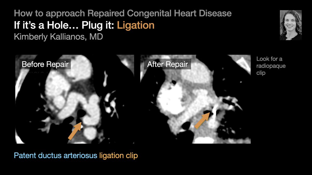 thoracicrad's tweet photo. A Plumber’s Approach to Repaired Congenital Heart Disease:

Hole → Plug it [2/5]

…from @KimKallianos’s talk at #STR2022 &amp; condensed by @MikeHarowiczMD.

#radres #Radtwitter #MedTwitter #FOAMrad #FOAMmed https://t.co/c0NMmWQqIw
