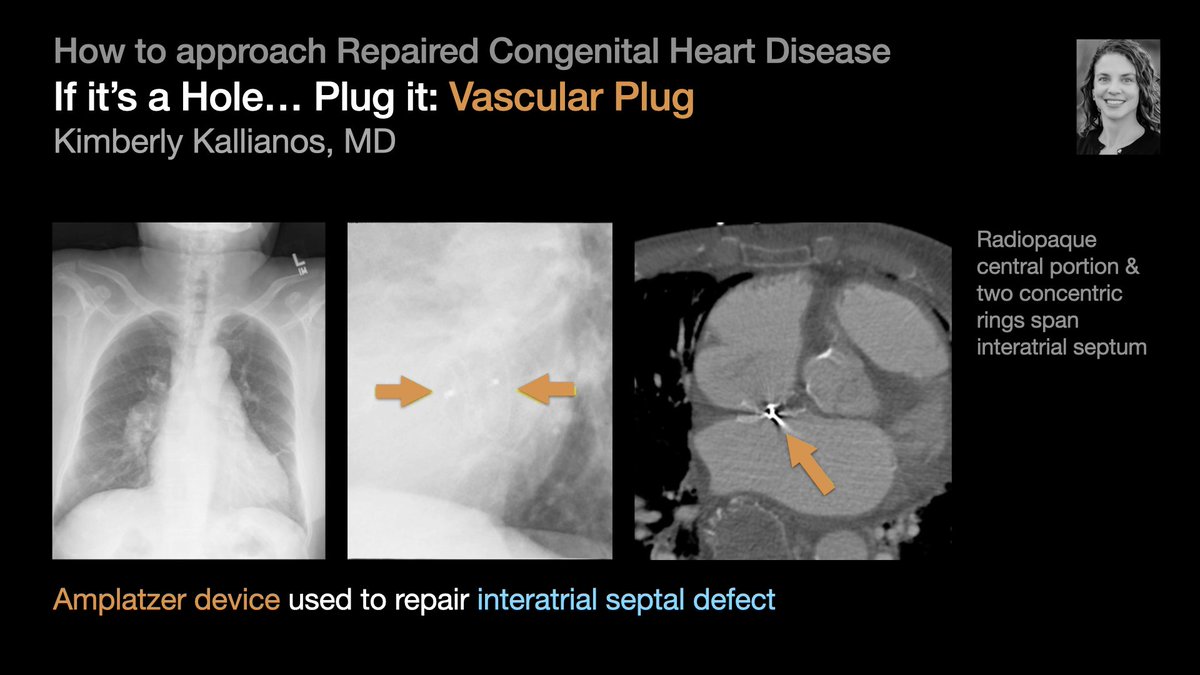 thoracicrad's tweet photo. A Plumber’s Approach to Repaired Congenital Heart Disease:

Hole → Plug it [2/5]

…from @KimKallianos’s talk at #STR2022 &amp; condensed by @MikeHarowiczMD.

#radres #Radtwitter #MedTwitter #FOAMrad #FOAMmed https://t.co/c0NMmWQqIw