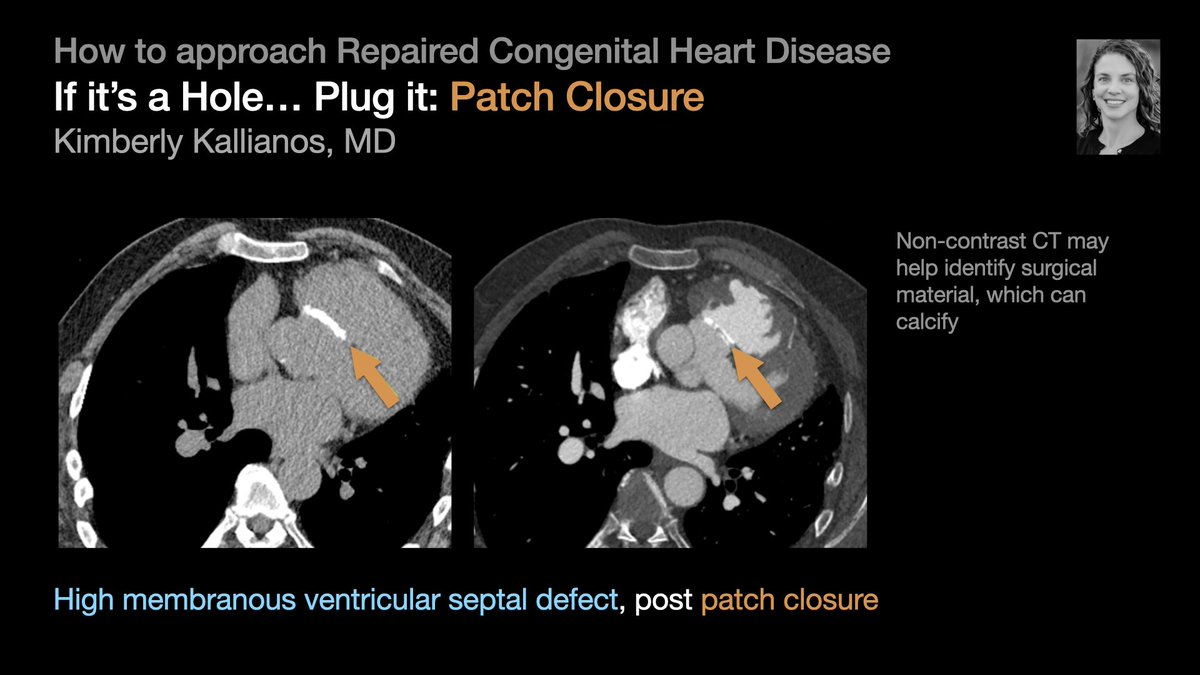 thoracicrad's tweet photo. A Plumber’s Approach to Repaired Congenital Heart Disease:

Hole → Plug it [2/5]

…from @KimKallianos’s talk at #STR2022 &amp; condensed by @MikeHarowiczMD.

#radres #Radtwitter #MedTwitter #FOAMrad #FOAMmed https://t.co/c0NMmWQqIw