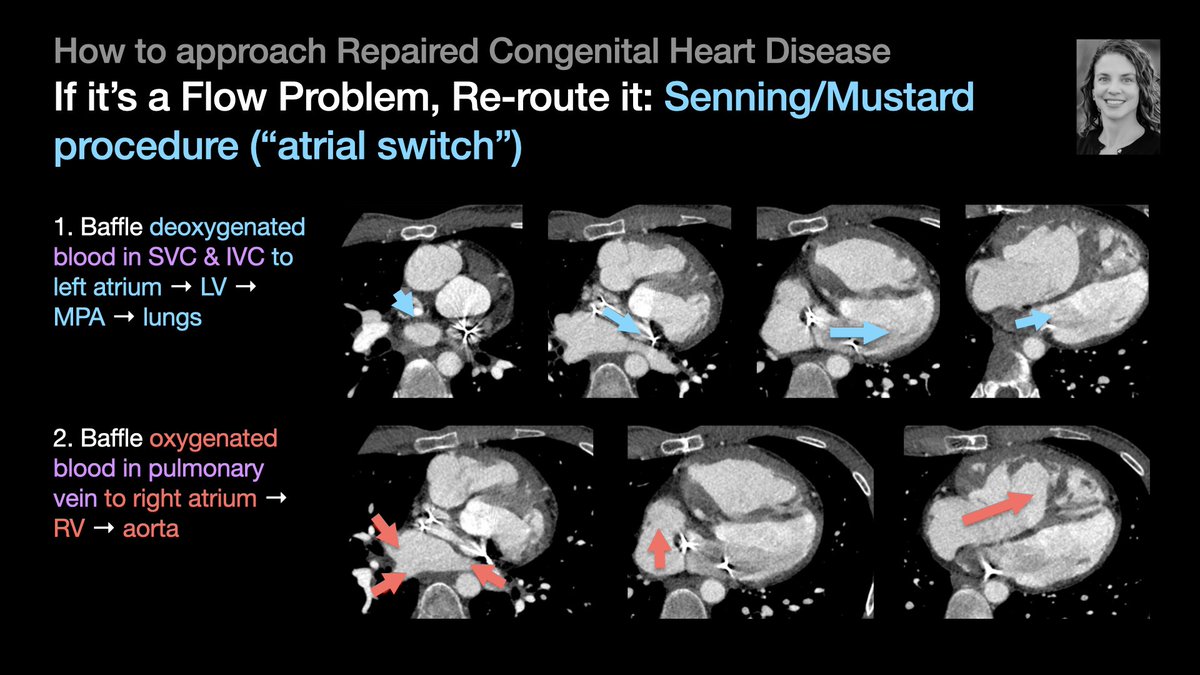 thoracicrad's tweet photo. A Plumber’s Approach to Repaired Congenital Heart Disease:

Flow problem → Reroute it [5/5]

…from @KimKallianos’s talk at #STR2022 &amp; condensed by @MikeHarowiczMD.

#radres #Radtwitter #MedTwitter #FOAMrad #FOAMmed https://t.co/F1eB7aM6uC